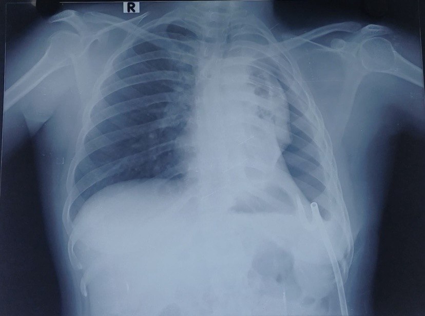 Case004 Preoperative Chest X-ray