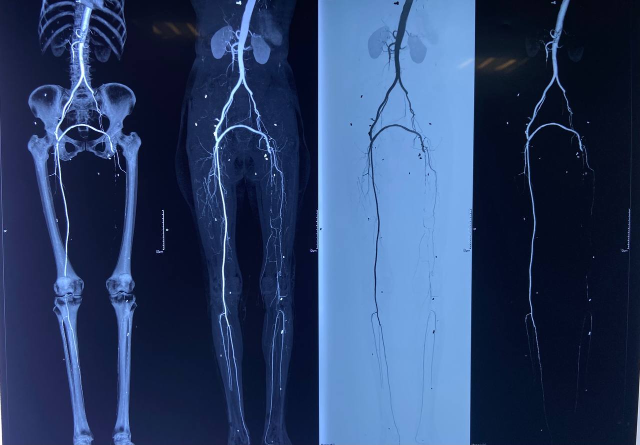 Case005 Preoperative CT Angiogram