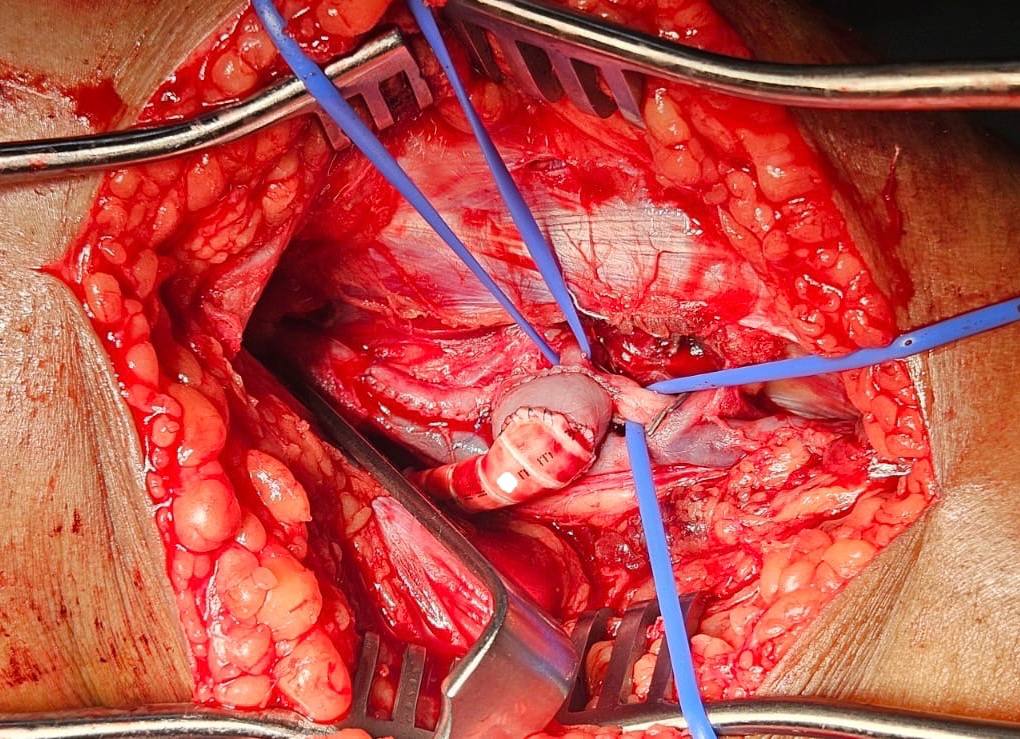 Case005 Intraoperative Graft Photograph